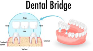 Read more about the article Dental Bridge Before and After: All Its Types and Potential Challenges