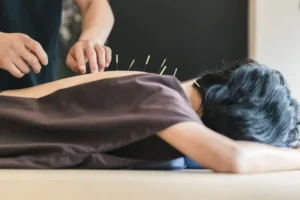 Read more about the article Top 10 Benefits of Acupuncture You Must Know