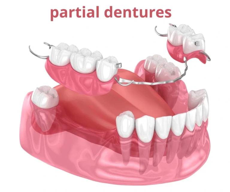 before and after partial dentures